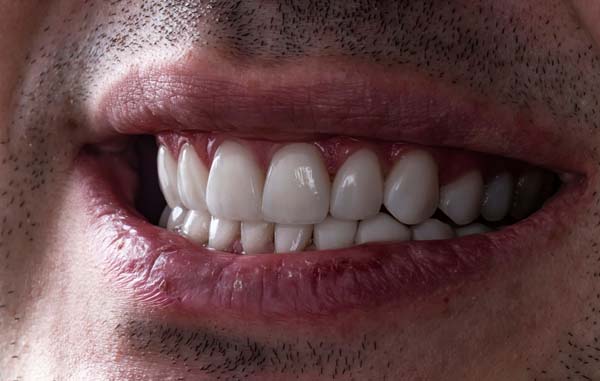 FAQs About Full Mouth Reconstruction
