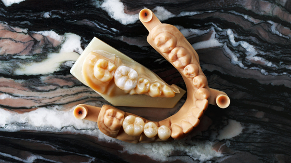 Implant Supported Dentures Can Solve The Problem Of Missing Teeth