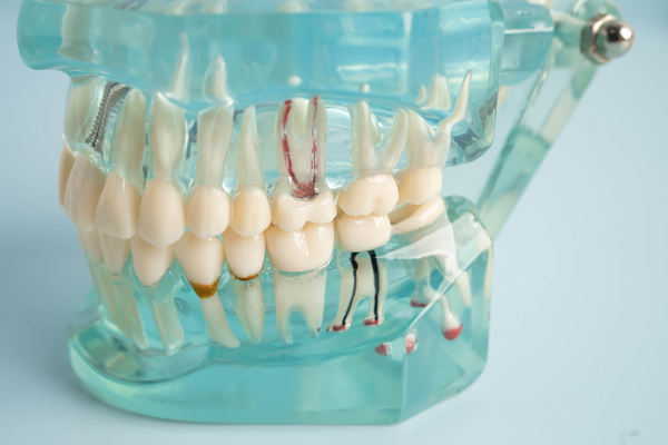 Why Do I Need A Crown After Root Canal Treatment?